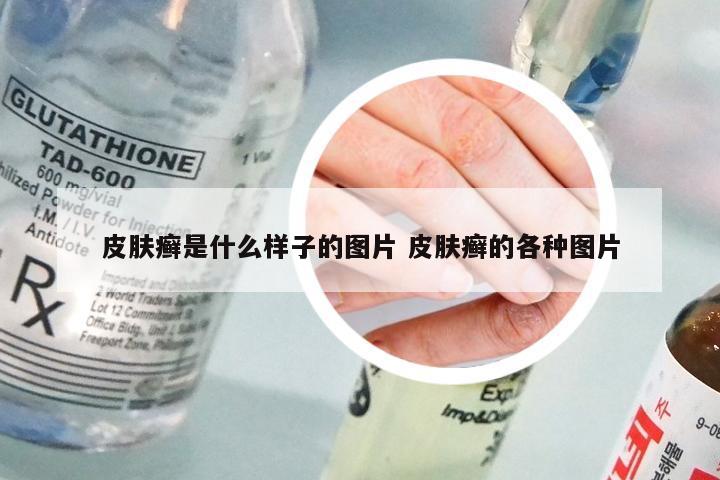 皮肤癣是什么样子的图片 皮肤癣的各种图片