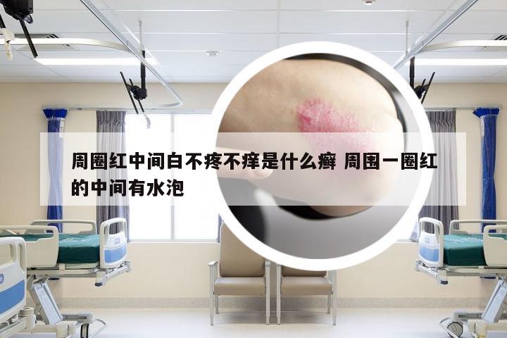 周圈红中间白不疼不痒是什么癣 周围一圈红的中间有水泡