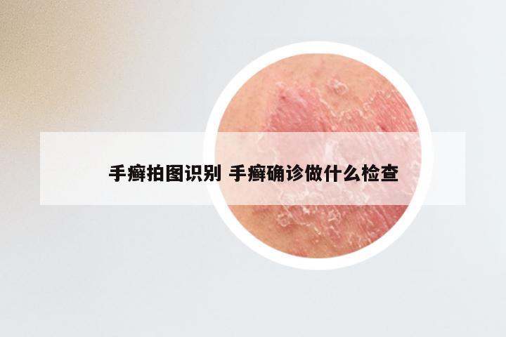 手癣拍图识别 手癣确诊做什么检查