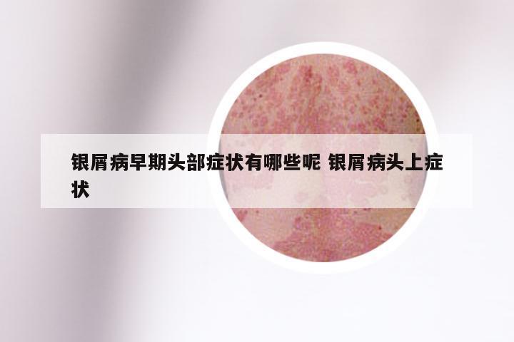 银屑病早期头部症状有哪些呢 银屑病头上症状