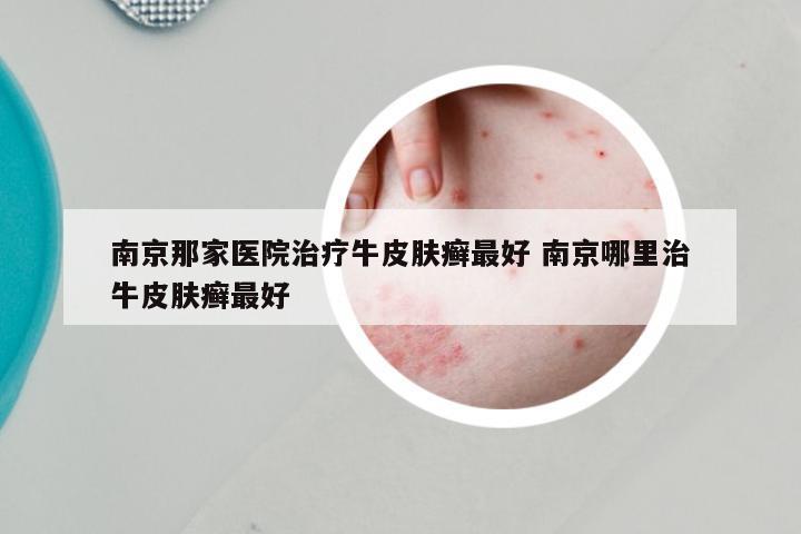 南京那家医院治疗牛皮肤癣最好 南京哪里治牛皮肤癣最好