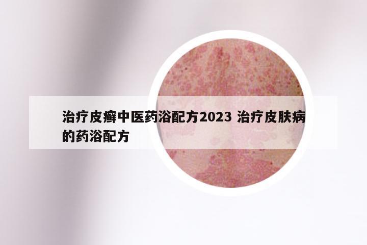 治疗皮癣中医药浴配方2023 治疗皮肤病的药浴配方