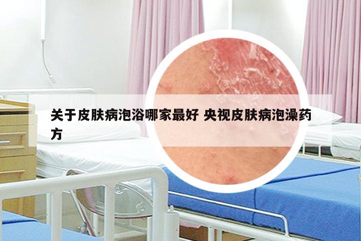 关于皮肤病泡浴哪家最好 央视皮肤病泡澡药方