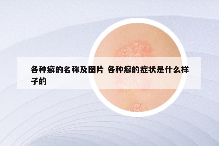 各种癣的名称及图片 各种癣的症状是什么样子的