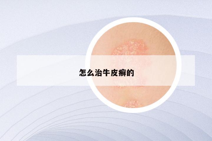 怎么治牛皮癣的