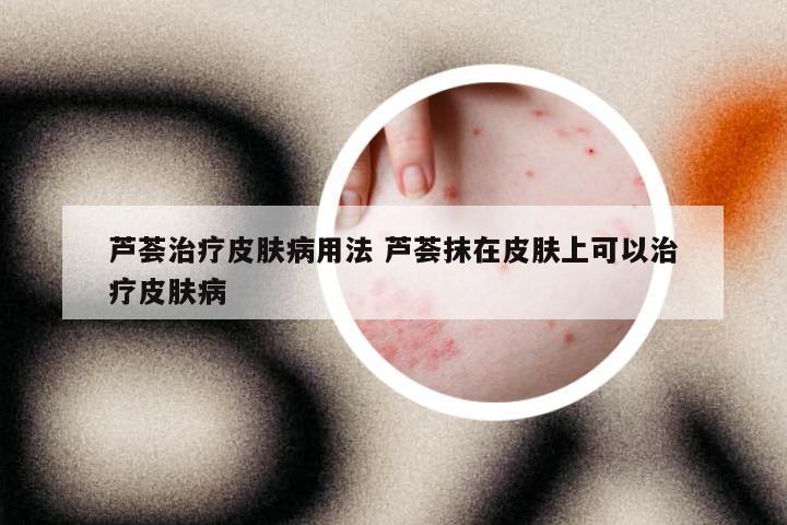 芦荟治疗皮肤病用法 芦荟抹在皮肤上可以治疗皮肤病