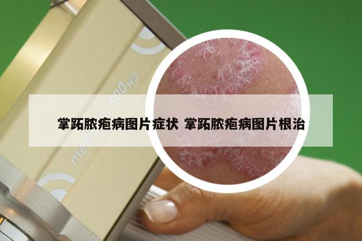 掌跖脓疱病图片症状 掌跖脓疱病图片根治