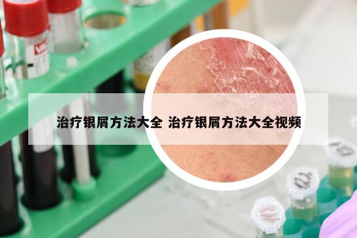 治疗银屑方法大全 治疗银屑方法大全视频