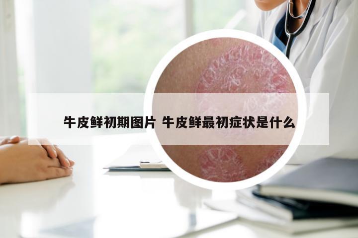 牛皮鲜初期图片 牛皮鲜最初症状是什么