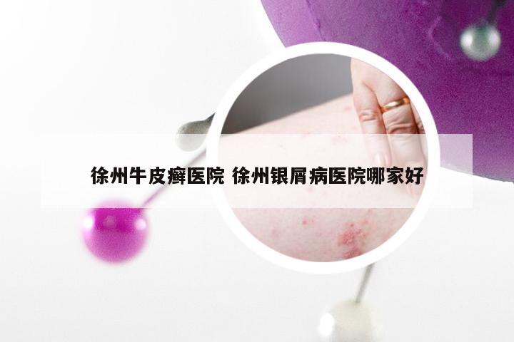 徐州牛皮癣医院 徐州银屑病医院哪家好