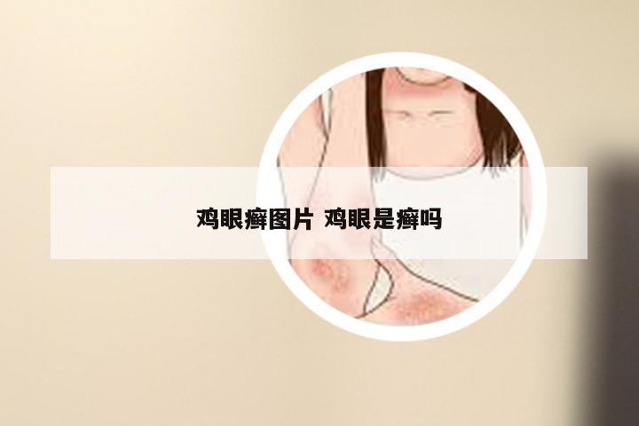 鸡眼癣图片 鸡眼是癣吗