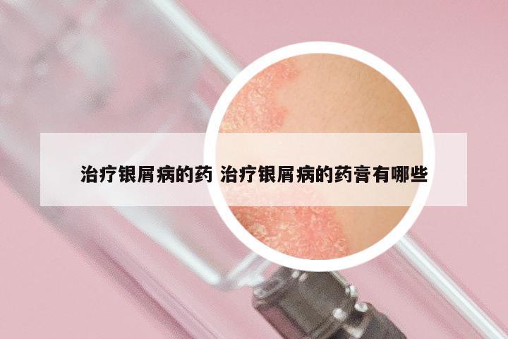 治疗银屑病的药 治疗银屑病的药膏有哪些