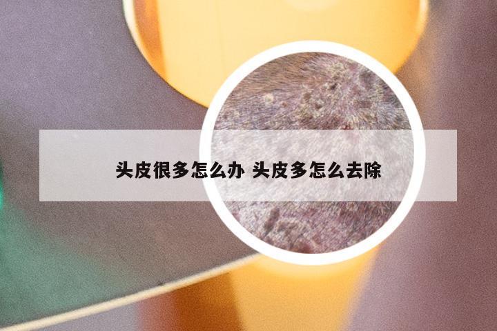 头皮很多怎么办 头皮多怎么去除