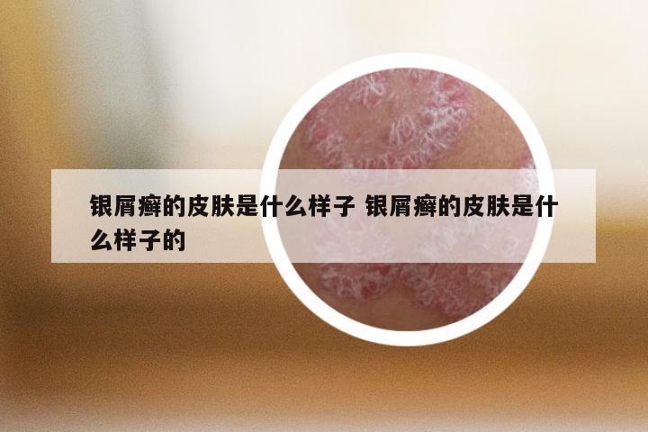 银屑癣的皮肤是什么样子 银屑癣的皮肤是什么样子的