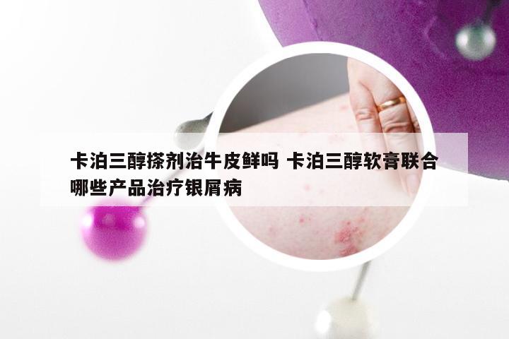 卡泊三醇搽剂治牛皮鲜吗 卡泊三醇软膏联合哪些产品治疗银屑病