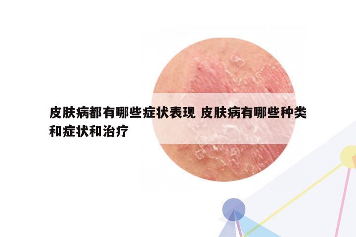 皮肤病都有哪些症状表现 皮肤病有哪些种类和症状和治疗
