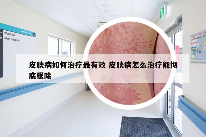 皮肤病如何治疗最有效 皮肤病怎么治疗能彻底根除