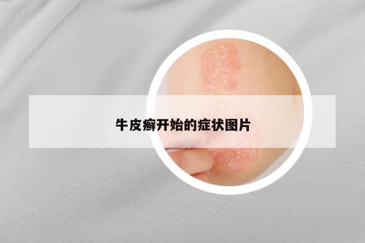 牛皮癣开始的症状图片