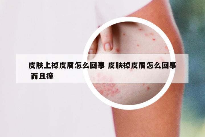 皮肤上掉皮屑怎么回事 皮肤掉皮屑怎么回事 而且痒