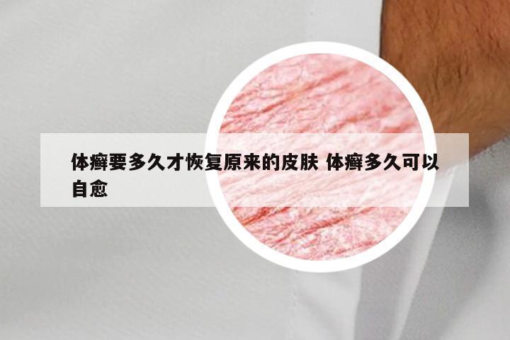 体癣要多久才恢复原来的皮肤 体癣多久可以自愈