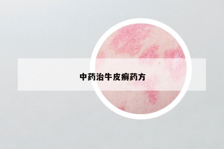 中药治牛皮癣药方