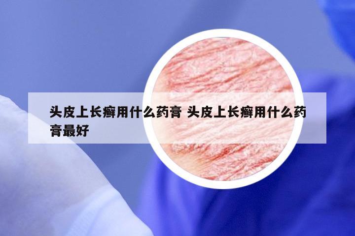 头皮上长癣用什么药膏 头皮上长癣用什么药膏最好