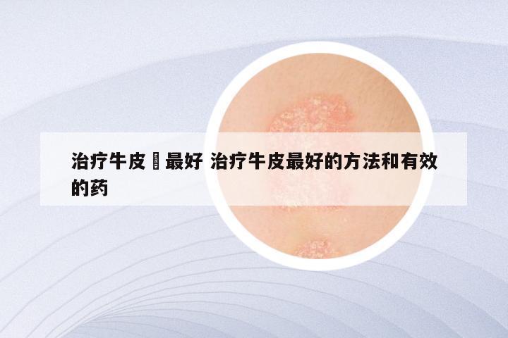治疗牛皮廯最好 治疗牛皮最好的方法和有效的药