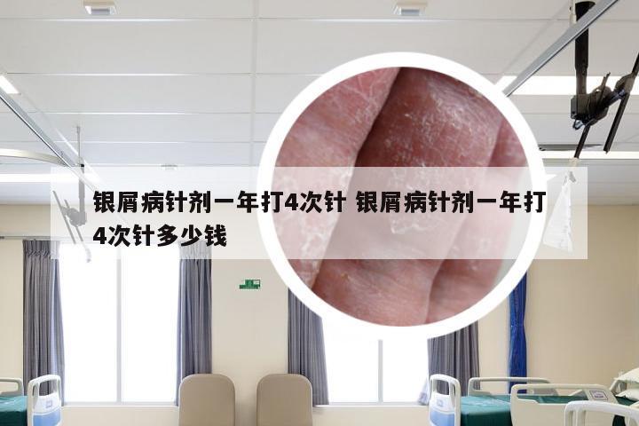银屑病针剂一年打4次针 银屑病针剂一年打4次针多少钱