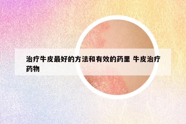 治疗牛皮最好的方法和有效的药里 牛皮治疗药物