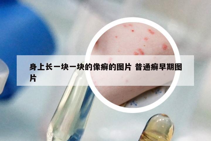 身上长一块一块的像癣的图片 普通癣早期图片
