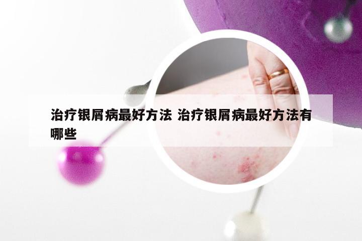 治疗银屑病最好方法 治疗银屑病最好方法有哪些