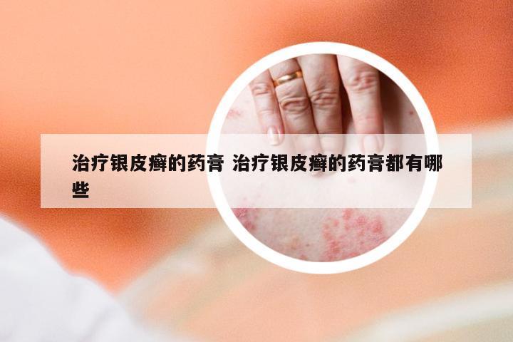 治疗银皮癣的药膏 治疗银皮癣的药膏都有哪些