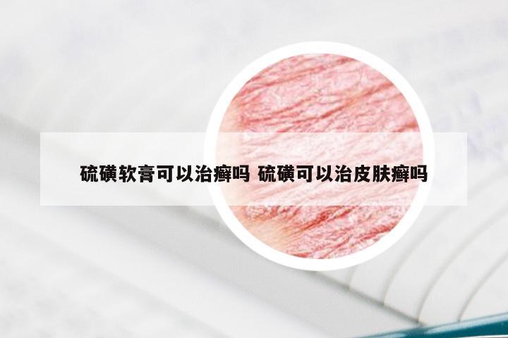 硫磺软膏可以治癣吗 硫磺可以治皮肤癣吗
