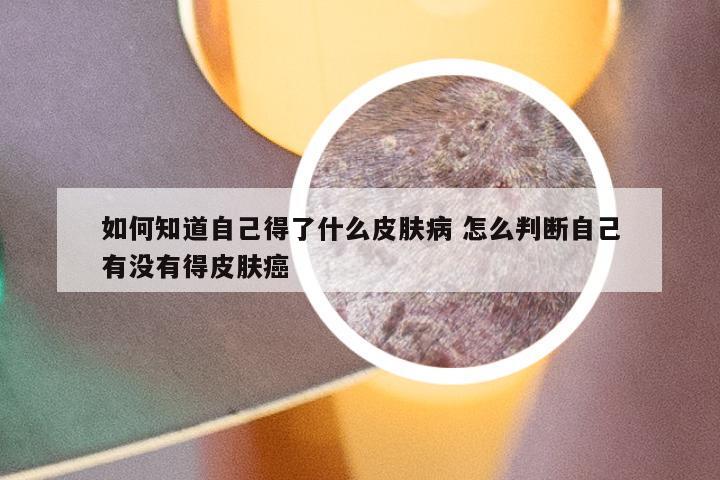 如何知道自己得了什么皮肤病 怎么判断自己有没有得皮肤癌