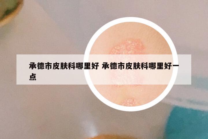 承德市皮肤科哪里好 承德市皮肤科哪里好一点
