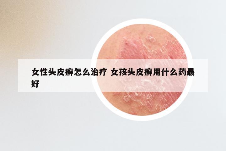 女性头皮癣怎么治疗 女孩头皮癣用什么药最好