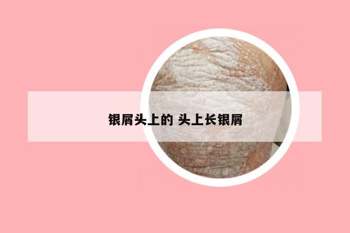 银屑头上的 头上长银屑