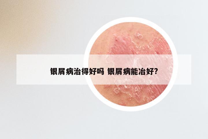 银屑病治得好吗 银屑病能冶好?