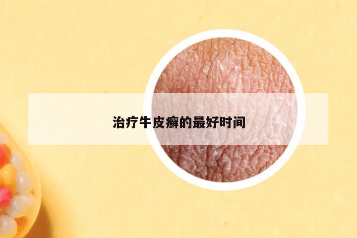 治疗牛皮癣的最好时间