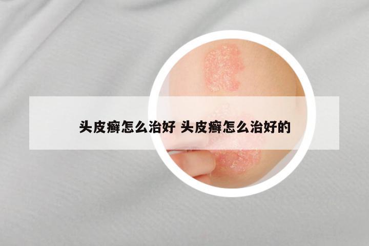 头皮癣怎么治好 头皮癣怎么治好的