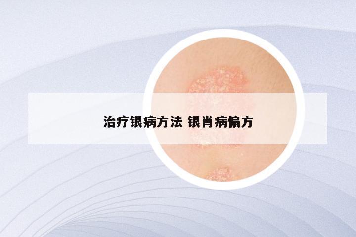 治疗银病方法 银肖病偏方