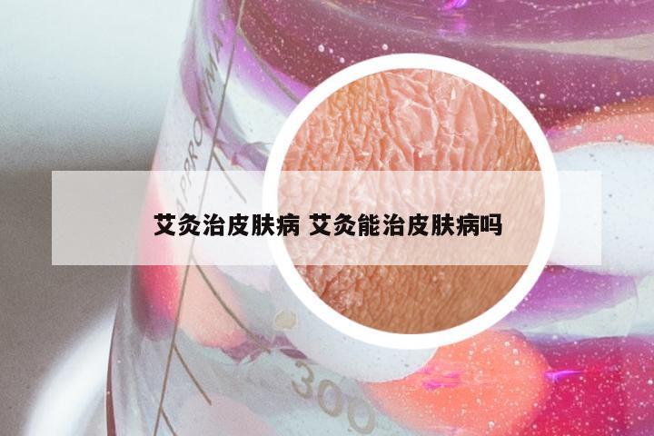 艾灸治皮肤病 艾灸能治皮肤病吗