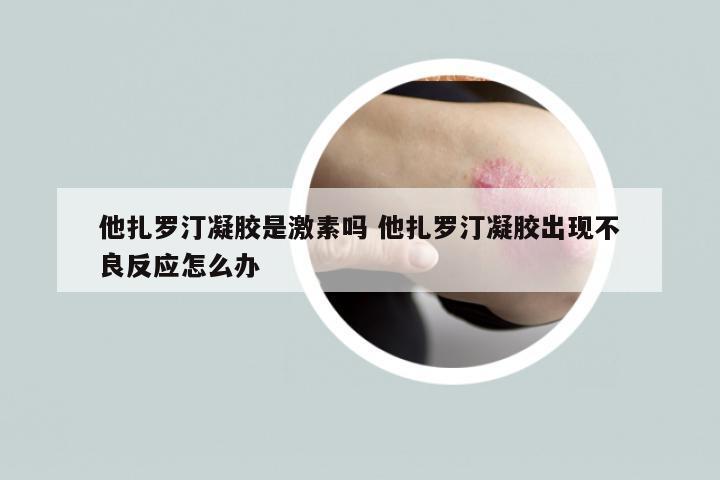 他扎罗汀凝胶是激素吗 他扎罗汀凝胶出现不良反应怎么办