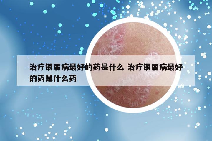 治疗银屑病最好的药是什么 治疗银屑病最好的药是什么药