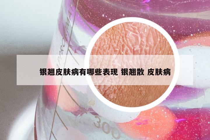 银翘皮肤病有哪些表现 银翘散 皮肤病
