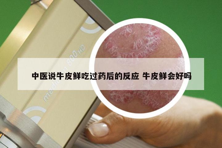 中医说牛皮鲜吃过药后的反应 牛皮鲜会好吗