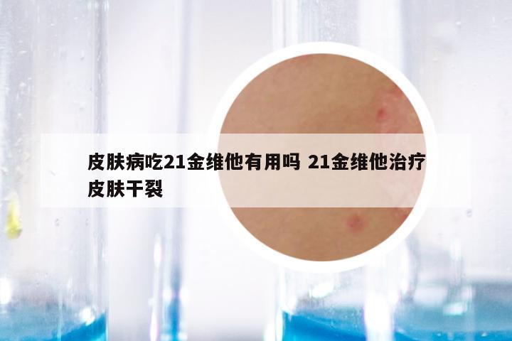 皮肤病吃21金维他有用吗 21金维他治疗皮肤干裂