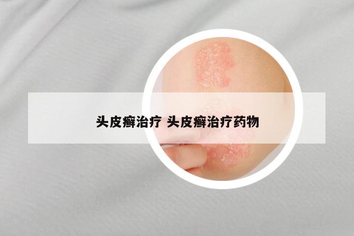 头皮癣治疗 头皮癣治疗药物
