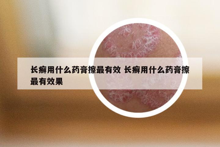 长癣用什么药膏擦最有效 长癣用什么药膏擦最有效果