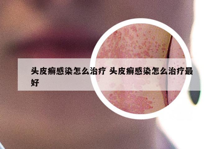 头皮癣感染怎么治疗 头皮癣感染怎么治疗最好